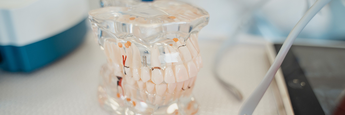 Dental Crowns Langford