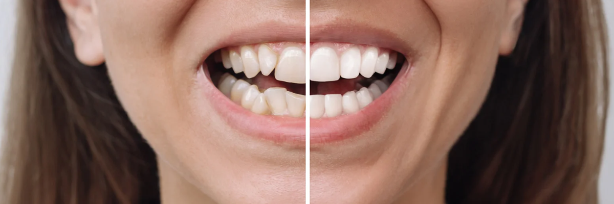 Cosmetic Dentistry Langford