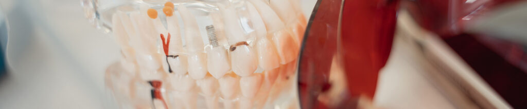 Dental Implants